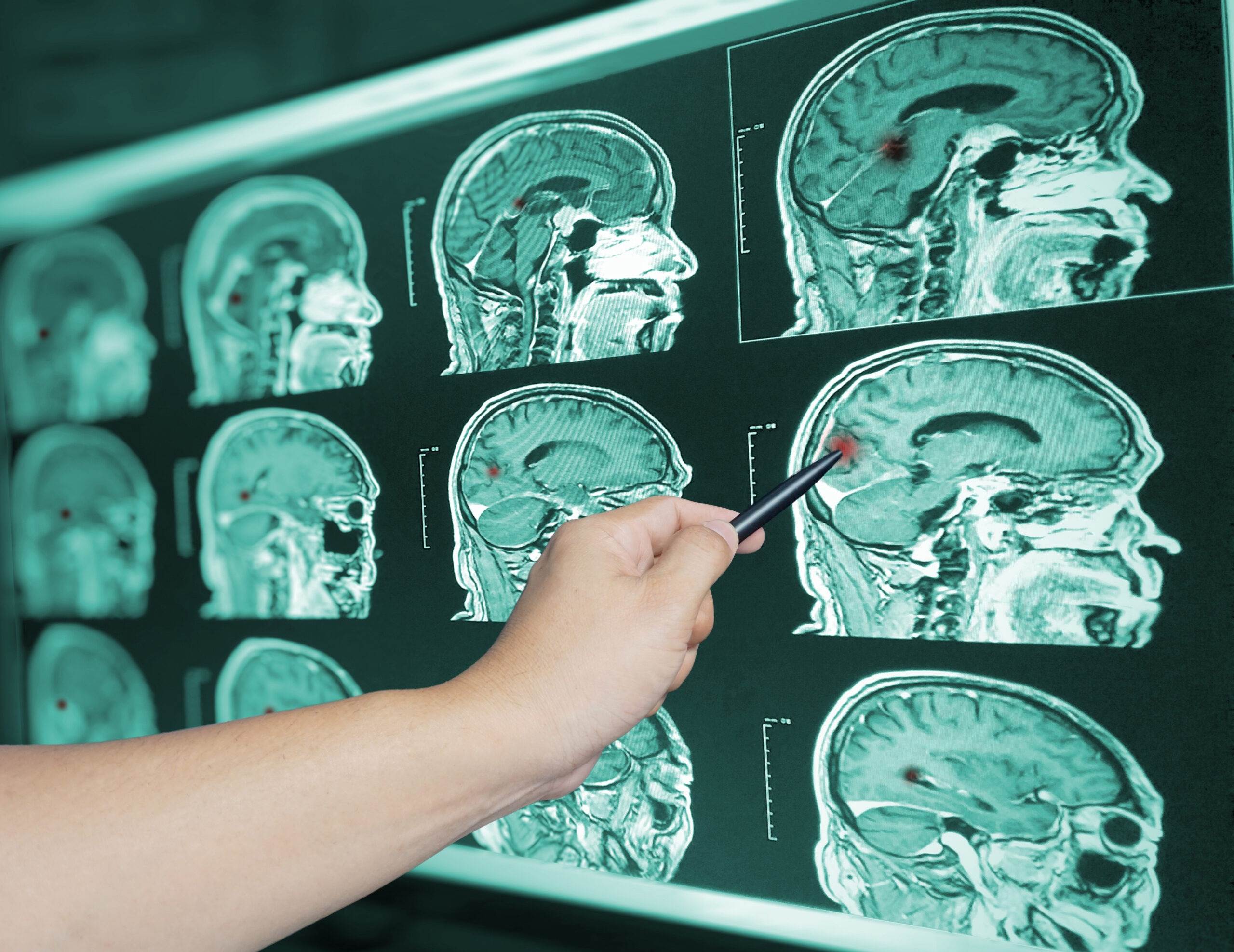 Doctor examining brain injury X-rays and scans to identify traumatic brain injury symptoms after an Indianapolis accident representing the medical evaluation process in a TBI claim