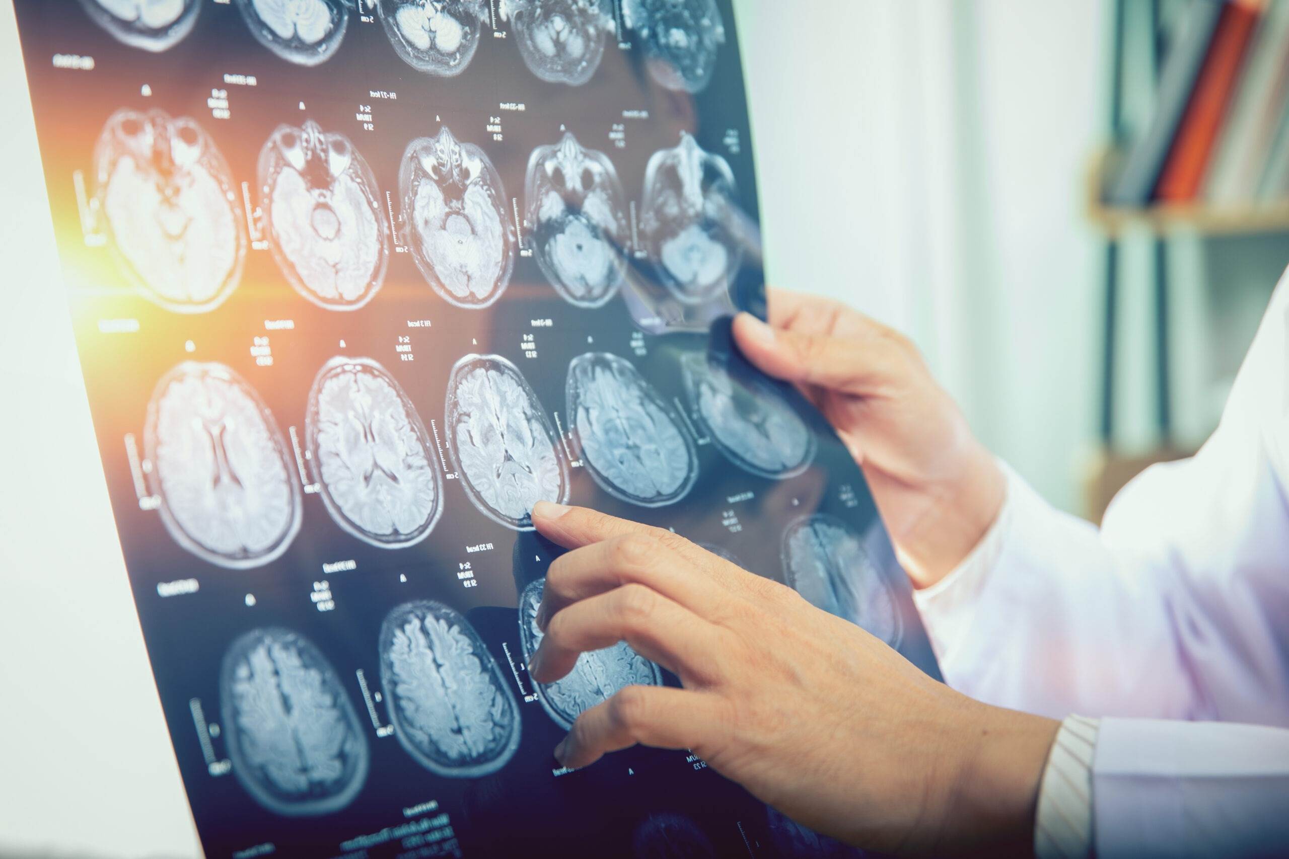 Medical professional holding a brain scan showing traumatic brain injury damage after an Indianapolis accident highlighting the importance of early TBI diagnosis for your claim