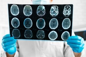 If you’ve been diagnosed with traumatic brain injury, speak with our TBI lawyers in Indianapolis for a free consultation.