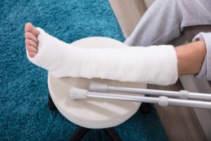 Bus accident victim with broken leg. A Mishawaka bus accident lawyer can help to pursue the maximum compensatory damages after an accident.